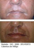 Vitiligo correção